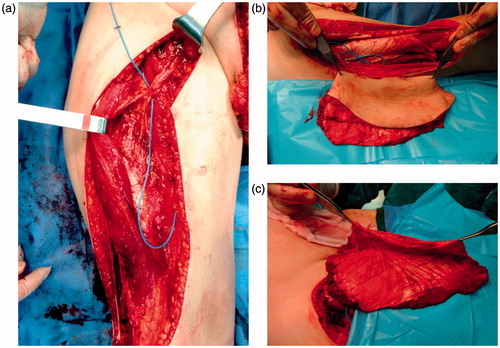 Figure 2. Intraoperative view showing the musculo-cutaneous muscle-sparing vastus lateralis flap including a portion of fascia lata (b and c) and the pedicle of the flap (a).