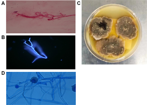 Figure 2 The morphology of R. pusillus. Hyphae forms of R. pusillus in sputum stained with Gram stain (A) Original magnification X 1000) and fluorescent stain (B), Original magnification X 400). R. pusillus colony grown in 28 ℃ PDA medium for 7 days. (C) Lactophenol cotton blue (LPCB) staining of the R. pusillus colony. (D), Original magnification X 400).