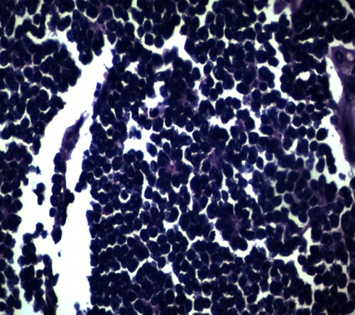 Figure 2 H& E stain (40X): Small round cells with perivesicular and pseudorosettes formation.