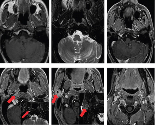 Figure 4. MRI at diagnosis of recurrence.