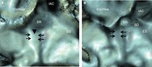 Figure 3. Representative views of the left ear of a patient with Meniere's disease (MD) (A) and a volunteer's healthy ear (B). (A) Although the outline of the bony groove of the reuniting duct (RD) (arrows), saccular duct (SD) and endolymphatic sinus (ES) can be traced, their luminal spaces seem to be occupied by a dense, bony substance. (B) On the other hand, those of the volunteer's healthy ear do not seem to be occupied by such a substance, and the luminal spaces maintain continuity. The arrowhead shows the discontinuity of the groove of the RD (arrows) in the MD patient. IAC, internal auditory canal; SR, saccular recess.