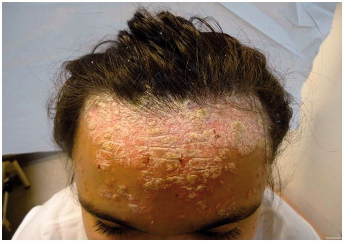 Figure 1. Before treatment with ustekinumab.