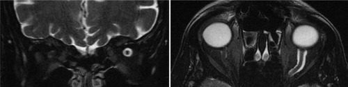 Figure 1 Axial (left) and coronal (right) fat-suppressed T2-weighted images of the orbits demonstrate enlarged CSF spaces around the normal appearing left optic nerve.