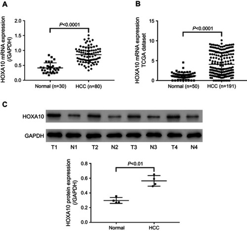 Figure 1 HCC tissues displayed elevated HOXA10 expression.Notes: (A) HOXA10 mRNA levels were detected by qRT-PCR in HCC tissues (n=80) and adjacent normal liver tissues (n=30). (B) HOXA10 expression in HCC tissues (n=191) and normal liver tissues (n=50) in TCGA LIHC dataset. (C) HOXA10 protein levels were detected in four pairs of HCC tissues (T1-T4) and adjacent normal liver tissues (N1-N4) by Western blot. GAPDH was used as the loading control.Abbreviations: HCC, hepatocellular carcinoma; HOXA10, homeobox A10; mRNA, messenger RNA; qRT-PCR, quantitative real-time PCR; TCGA, the cancer genome atlas; LIHC, liver hepatocellular carcinoma; GAPDH, glyceraldehyde 3-phosphate dehydrogenase.