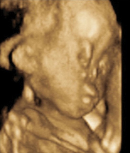 Figure 4 3-D rendering of the fetal face, showing mid-facial hypoplasia.