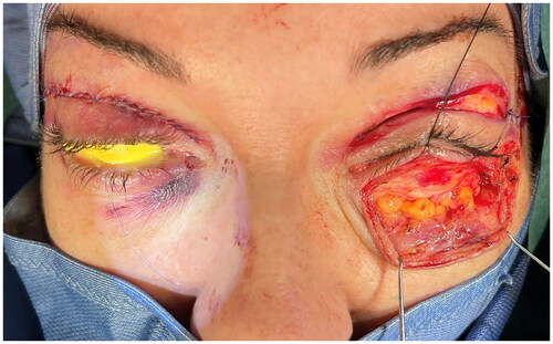 Figure 2. Intraoperative view of the fat compartments’ prominence of the left lower eyelid before conservative excision; corneal protectors were used during surgery.
