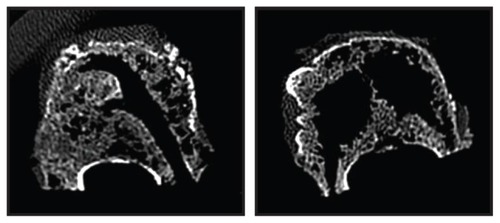 Figure 4 Computed tomography images of vertebrae following cavity creation, prior to cement augmentation.