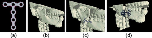 Figure 15. The modeling and attachment of rigid bone plates. (a) The surface of a bone plate after sampling and extrusion. (b) A bone surface before modification. (c) The same bone surface after drilling, distraction, and plate attachment. (d) The same bone surface after drilling, distraction, and distractor insertion. [Color version available online.]