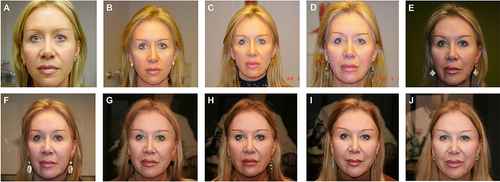 Figure 2 Representative photographs of a patient treated with onabotulinumtoxinA over an 18-year period. This patient began receiving onabotulinumtoxinA in December 2000, but no digital photographs were available until 2006. Photos were taken upon arrival to the clinic, and images from an interval of approximately every 1–2 years are shown as follows: 2006 (A), 2008 (B), 2010 (C), 2012 (D), 2014 (E), 2016 (F), 2018 (G), 2020 (H), 2022 (I), and 2023 (J). On average, the patient received 3 sessions per year from March 2006 (age, 43 years) to June 2023 (age, 60 years), totaling 58 clinic visits, including 5 touch-ups. The total dose of onabotulinumtoxinA per treatment session for glabellar frown lines, horizontal frontal rhytids, and canthal lines varied between 40 and 60 units.
