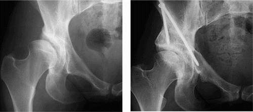 Figure 7. Radiograph before and six months after periacetabular osteotomy. Preoperatively, insufficient coverage of the femoral head as well as an oblique acetabular roof is seen. Postoperatively, the femoral head is covered by the acetabulum and the acetabular roof is horizontal.