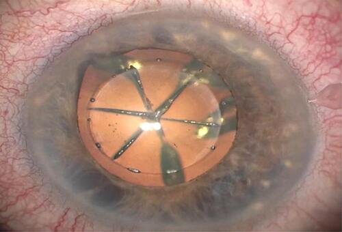 Figure 7 Fragmented nucleus, right eye.