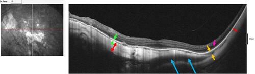 Figure 3 Near infrared reflectance image (left panel) and B-scan OCT image (right panel) of a 68-year-old woman with pathologic myopia. The scleral thickness varies widely (compare the red double-head arrows in nasal and temporal macula, respectively). Where the sclera thins and bows outward, the choroid thickens (space between the two yellow arrows) compared to the choroidal thickness overlying thick sclera (space between two green arrows). However, instead of a choroidal cavitation, the associated response seen is outer nuclear layer retinoschisis (purple arrow). The blue arrows indicate a large intrascleral vein.