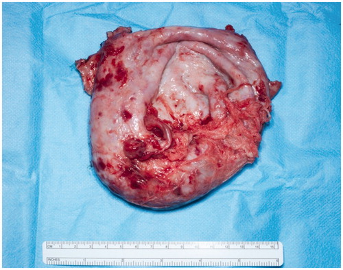 Figure 4. Post resection Intraoperative view of the large encapsulated seroma.