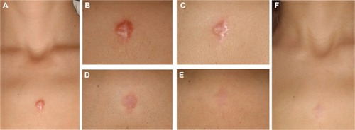 Figure 1 Baseline photograph at presentation in our scar clinic before initiation of combination therapy with cryotherapy directly followed by intralesional TAC (10 mg/mL) (A and B). Result after three cycles of combined cryo/intralesional TAC therapy before initiation of PDL (C). Result after four PDL applications (D). No signs of recurrence or reactivation at follow-up 6 months after the last laser treatment (E and F).