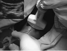 Figure 3 Ultrasound guided IJV cannulation.