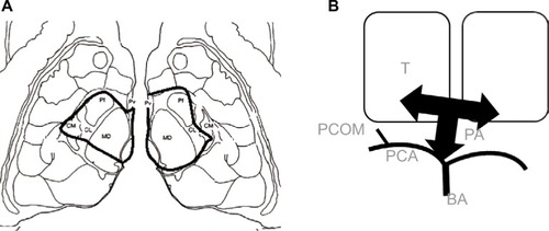 Figure 1 (A) Schematic representation of the affected thalamic nuclei in this case compared to an axial diffusion-weighted magnetic resonance image of the same patient. The black line limits the area of infarction in both paramedian regions. (B) Schematic representation of the artery of PA, T, BA, PCA, and PCOM.