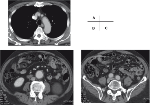 Figure 2 Contrast computed tomography three weeks after steroid therapy at the level of aortic arch and its branches A) abdominal aortic aneurysm, B) and common iliac arteries C).