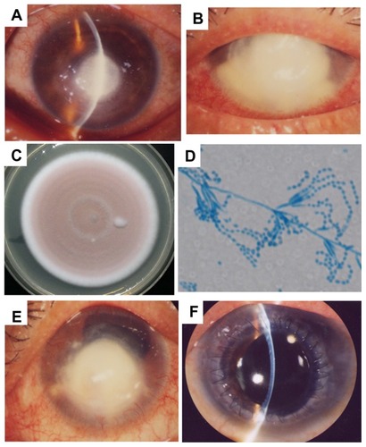 Figure 1 Case 1. (A) The round, central corneal infiltrate with feathery margins is surrounded by a severely edematous cornea. (B) Enlargement of the infiltrate at 2.5 weeks after discontinuing corticosteroids and starting antifungal agents. (C) Colony of Paecilomyces lilacinus isolated from cornea, and the color of colony in 14 days is lilac on potato dextrose agar. (D) Photomicrograph of P. lilacinus demonstrating the long conidiophores arising from hyphae, tapering phialides, and chains of conidia (lactophenol cotton blue stain). (E) Two weeks after starting treatment with voriconazole, the infiltrate has decreased in size. (F) Two years after the discharge, the cornea is clear and no recurrence of fungal infection has been reported.