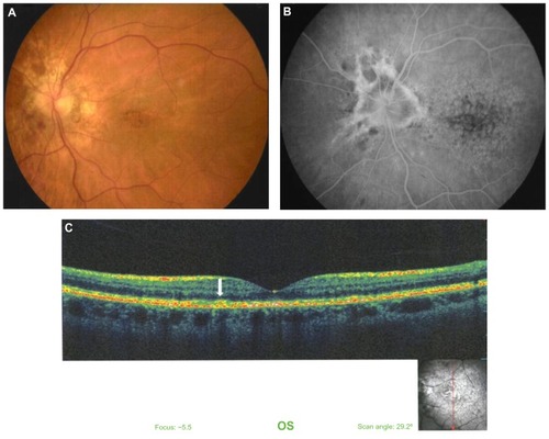 Figure 2 Left eye of the same patient. Color photograph of the fundus of the eye. (A) Early fluorescein angiography phase, depicting the hyperpigmented granuloid-like appearance of the macula. (B) Late fluorescein angiography phase, showing the angioid streaks and the hypopigmented and hyperpigmented lesions of the macula. (C) Vertical optical coherence tomography scan through the fovea.