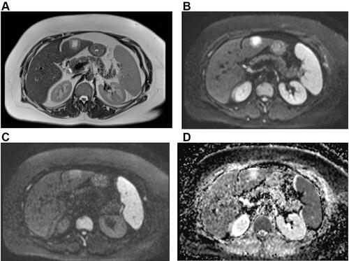 Figure 1 MRI scan displaying segment II subcapsular typical liver hemangioma in a 48-years old case (prepared with castor oil). (A) The lesion is hyperintense on T2WI. (B) The hemangioma is hyperintense at b value 50 mm2/s, whereas (C) moderately hyperintense at b values 800 mm2/s. (D) The quantitative ADC data of the lesion is (2.108 ± 0.13 ×10−3 mm2/s).