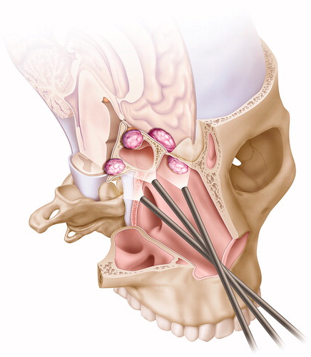 Figure 3. Endonasal endoscopic approaches. Copyright Holt Medical Illustration.