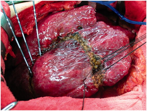Figure 2. Electrodes were inserted into the pre-determined resection plane in a linear arrangement to conduct ablation.