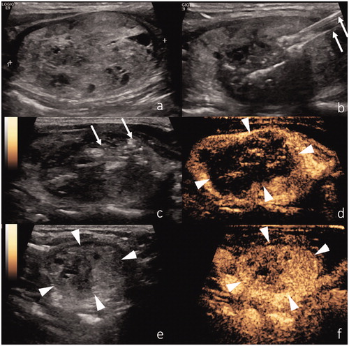 Figure 1. (a) US representation of a benign thyroid nodule. (b) Two laser applicators have been introduced within the nodule, with a distance of ∼5 mm between the needle tips. (c) Gas bubbles in the nodule are the immediate effect of thermal ablation. (d) Immediate post-procedural CEUS shows lack of contrast enhancement in the central part of the nodule. (e) Six-month follow-up shows volumetric reduction of the ablated nodule. (f) CEUS of the ablated nodule shows shrinkage and low vascularization of the inner core of the nodule, due to cicatricial effects.