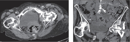 Figure 2. CT scans showing the canal through which the hip pin had migrated through the femoral head and the pelvic bone before entering the abdomen.