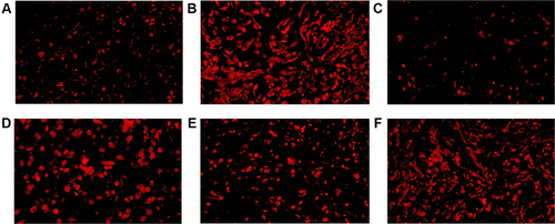 Figure 5 CD8+ TILs in tumor microenvironment of mice inoculated with breast cancer cells. (A) Inoculation of 4T1 cells. (B) Inoculation of 4T1 cells and metformin administration. (C) Inoculation of 4T1 cells with JNK knock-down. (D) Inoculation of 4T1 cells with JNK overexpression. (E) Inoculation of 4T1 cells with JNK knock-down and metformin administration. (F) Inoculation of 4T1 cells with JNK overexpression and metformin administration.