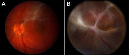 Figure 1 ADNIV disease stages. (A) Stage III ADNIV shows epiretinal membrane and tractional edema. (B) Stage IV shows tractional retinal detachment.