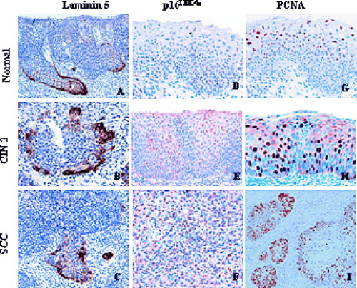 Figure 3.  Coexpression of laminin-5 γ2 chain, p16 INK4a and PCNA in samples from normal epithelium, different CIN stages, and invasive cervical cancer.