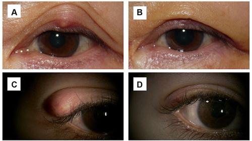 Figure 1 Eyelid photographs before and 1 week after chalazion surgery.