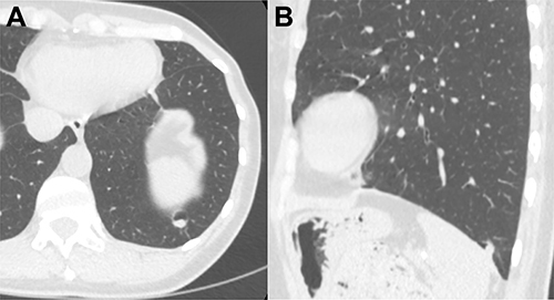 Figure 2 A shrunken lung cyst with mural nodule at posterior wall was detected in the original location two years later, with a strip between the cyst and pleura. (A) axial image, 2021; (B) sagittal reformation image, 2021.