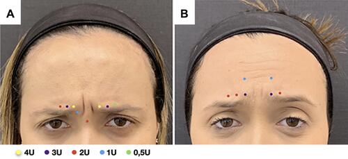 Figure 4 One21 assessment and personalized treatment plan based on glabellar line patterns. (A) Asymmetric glabellar lines: Prominence of right orbicularis and depressor supercilii. (B) Involvement of frontalis and right orbicularis in dynamic glabellar line formation.
