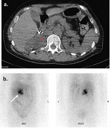 Figure 3. Α) Abdominal CT in a 58-year-old female showing a 4x4x2 cm tumor-like lesion in the anatomical region of the right adrenal gland, with kidney dislocation and retroperitoneal extension behind the inferior vena cava. Β) Anterior and posterior planar views of 123Ι-ΜΙBG-SPECT/CT scintigraphy showing a soft tissue mass with increased tracer uptake (arrow) in the anatomical area of the excised right adrenal gland extending to the retroperitoneal space. Findings compatible with local recurrence of pheochromocytoma.