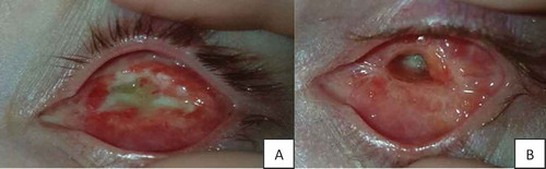 Figure 10. (A) Socket infection 1 month postoperative. (B) Central hole postinfection.