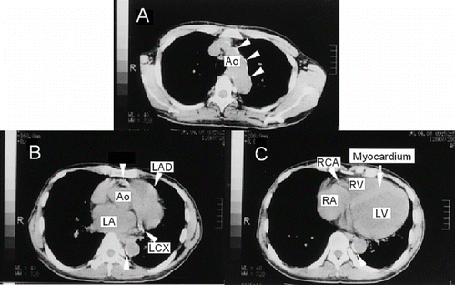 Figure 2. X-ray computed tomography image without contrast media at the level of (a) aortic arch, (b) aortic root, and (c) left ventricle. Arrow heads show calcification of the aorta and the coronary arteries. Abbreviations: Ao = aorta, LA = left atrium, LV = left ventricle, RV = right ventricle, LAD = left anterior descending artery, LCX = left circumflex, RCA = right coronary artery.