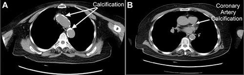 Figure 1 Localized high-density calcium deposition was observed in the aortic arteries (A) and coronary arteries (B). The white arrow in (A) shows the calcification in the artery wall of aorta; the white arrow in (B) indicates the calcification in coronary artery wall.