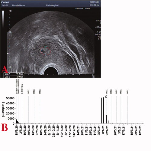 Figure 6. (A) Transvaginal ultrasound at 1-month post-discharge follow-up. (B) Serum β-hCG levels throughout the disease duration for case two.