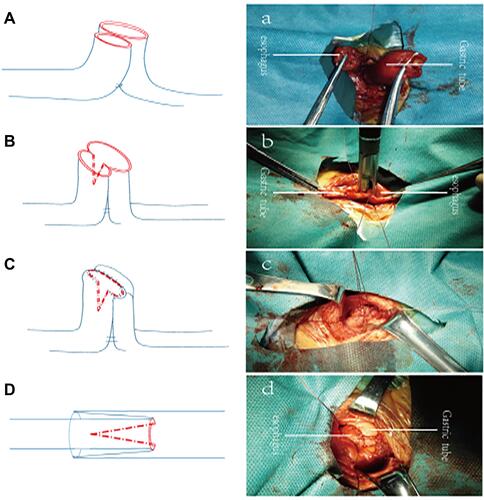 Figure 3 The “side-to-side, end-to-end, embedded anastomosis” of the esophagus and stomach. (A)a.Suture and fix at the root of gastric tube and esophagus. (B)b “side-side” anastomosis of the gastric tube and esophagus. (C)c “end-end” anastomosis of gastric tube and esophagus. (D)d “sleeve” anastomosis.