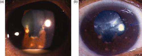 FIGURE 1. (a) Anterior segment photograph of left eye at presentation showing the presence of Koeppe nodules at the pupillary border, broad-based posterior synechiae, and hypopyon. (b) Anterior segment photograph showing resolution of hypopyon.
