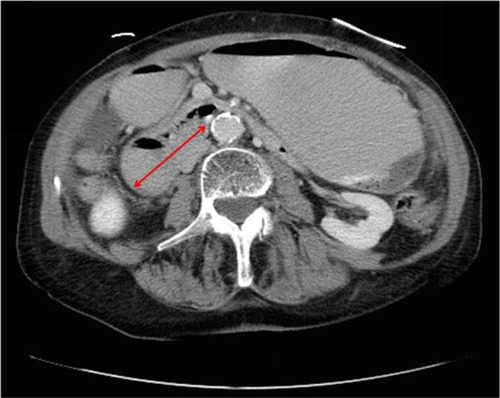 Figure 2 Computed tomography of the abdomen showing gastric and duodenal distention (red arrow) indicating obstruction at the level of the superior mesenteric artery.