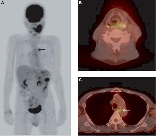 Figure 2. A. Maximum intensity projection (MIP). B,C. Transaxial PET/CT. A 68-year-old man (Case 14). An FDG-PET/CT image shows focal FDG uptake on the left side of the hypopharynx (SUVmax, 4.4), bilateral neck lymph nodes (SUVmax, 8.2), and the left lower jaw (SUVmax, 18.1), which was already identified as a mandibular neoplasm. The additional detection of FDG uptake (arrow) was observed from the upper to middle thoracic esophagus (SUVmax, 3.8). This case was considered to possibly reflect an inflammatory change, such as reflux esophagitis, because the distribution of the FDG uptake was diffuse, rather than focal; thus, we diagnosed the FDG-PET/CT image as equivocal. The uptake was subsequently confirmed to represent an esophageal cancer (T1b) based on the EGD findings.