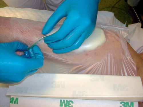 Figure 4. Wrapping the drape around the suction tube.
