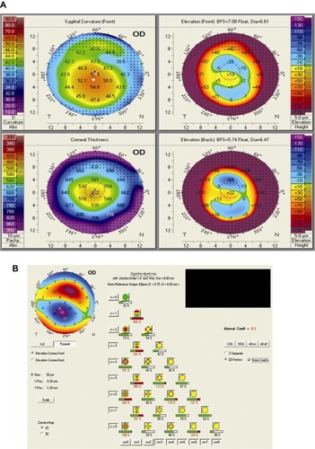 Figure 1 Corneal topography and wavefront aberration measurements prior to the ring placement.