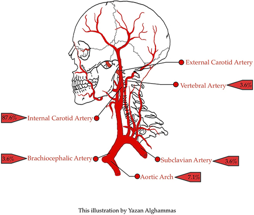 Figure 1 Distribution of intraluminal thrombus in the extracranial arteries. The most common location of ILT was ICA followed by the aortic arch. Reproduced with permission from Yazan Alghammas as this figure has been drawn specifically for this research project.