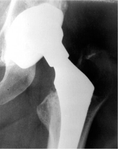 Figure 3A. Anterior/posterior radiograph of a 51-year-old woman taken 7 years after THA, and before the fracture, shows an osteolytic cyst on the greater trochanter and severe polyethylene wear.