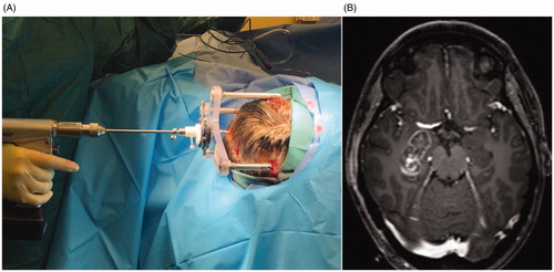 Figure 1. LITT Procedure. (A) Probe insertion through the StarFix frame (FHC Inc.) via an occipital entry. (B) Extent of laser ablation of the right amygdala, hippocampus, PHG and entorhinal cortex. Unpublished property of Dr. Joseph Neimat.