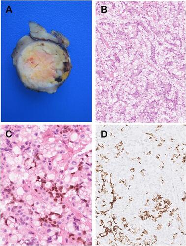Figure 1 (A) Gross appearance of primary renal tumor, showed yellowish, solid mass surrounded by a thin layer of normal kidney parenchyma. (B) The tumor showed a biphasic proliferation of glandular metastatic structures admixed within chromophobe renal cell carcinoma in a perfect symbiosis (hematoxylin and eosin; original magnification × 200). (C) Intestinal marker CDX2 was expressed only in scattered cells arguing for gastric origin. (D) Gastric tumor cells showing typical expression of hepatic marker HSA.