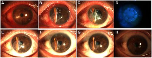 Figure 7 Successful graft transplantation in the infectious peripheral corneal ulcer group. (A–D) Before surgery (A) and at 1 day (B), 7 days (C and, D), 1 month (E), 3 months (F), 6 months (G), and 12 months (H) postoperatively.